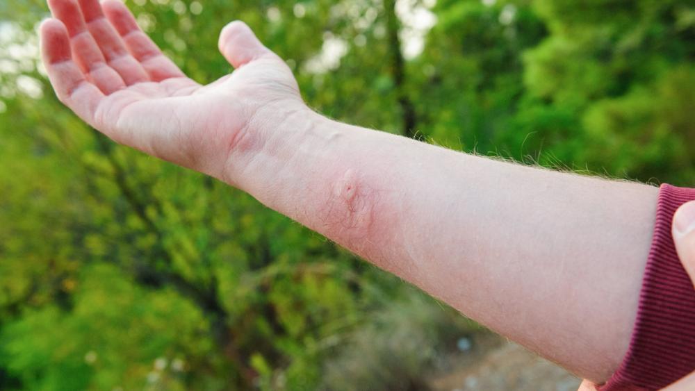 The Medical Minute: Surviving summer's biting bugs | Penn State University